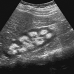 ultrazvok ledvic